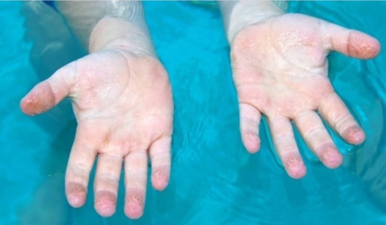 Por Que Ficamos Com Os Dedos Enrugados